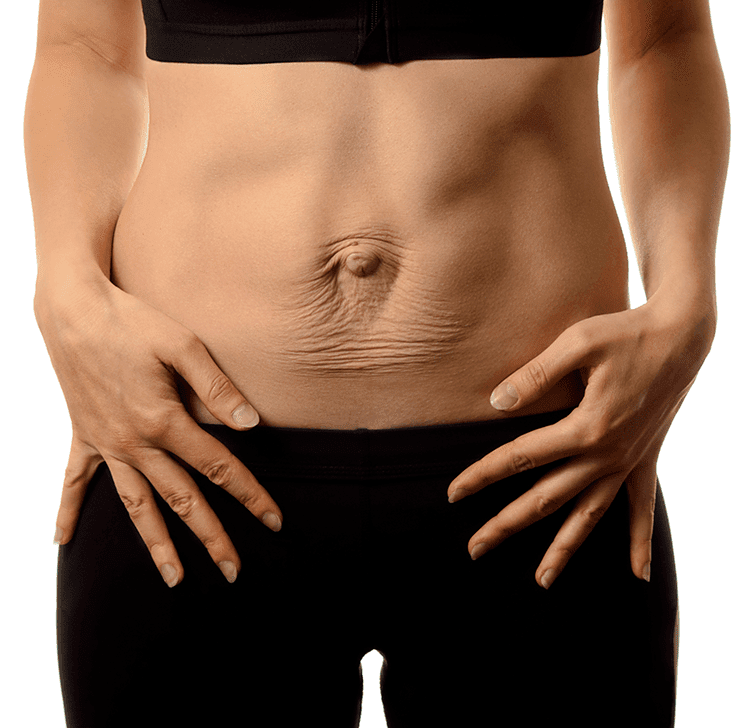 Is abdominal separation affecting your life?